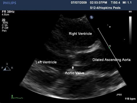 Aortic stenosis - Cancer Therapy Advisor