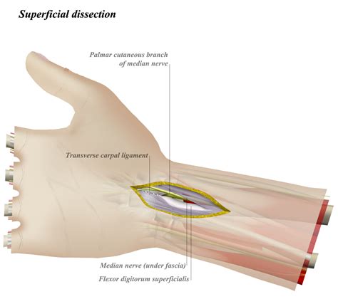 Volar Approach to Wrist - Approaches - Orthobullets