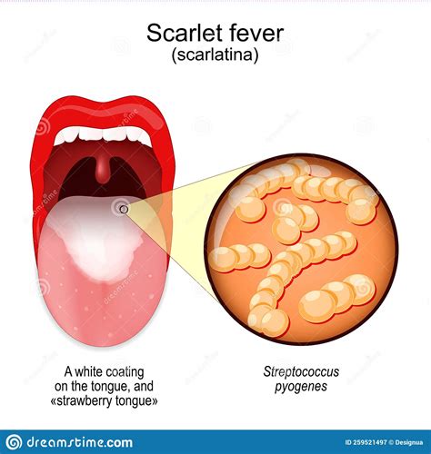 Scarlet Fever. Mouth with Symptoms of Scarlatina Stock Vector ...