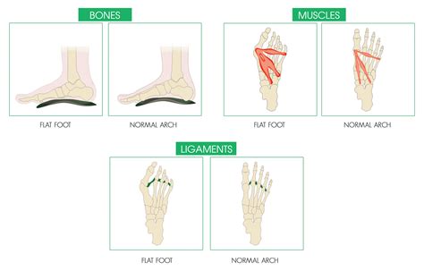 Three steps to fixing flat feet | Dubai Podiatry Centre