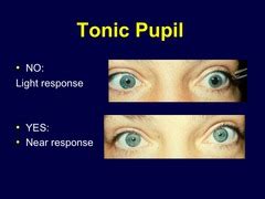 Tonic Pupil; Pupil, Tonic; Adie's Pupil