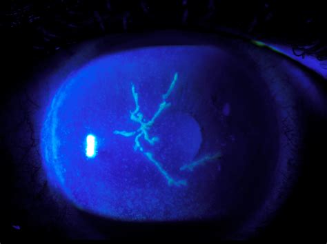 Moran CORE | Fluorescein