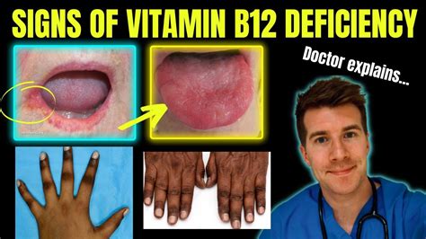 Vitamin B12 Deficiency Symptoms Tongue