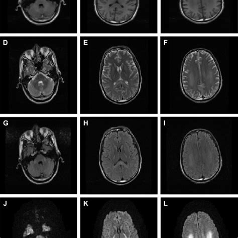 Brain MrI results: bilateral posterior limb of internal capsule,... | Download Scientific Diagram