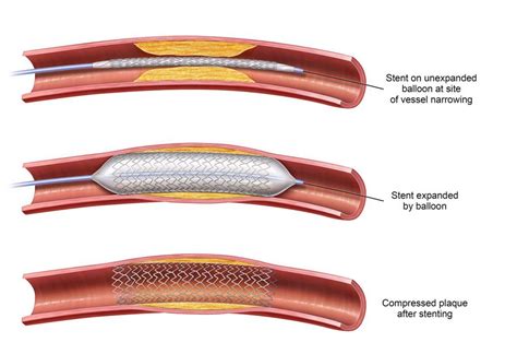 Atherosclerosis and Peripheral Artery Disease | Azura