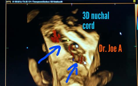 Ultrasound imaging: Nuchal-cord-double-loop