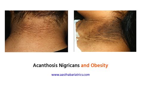 Acanthosis Nigricans & Obesity - Aastha Bariatrics