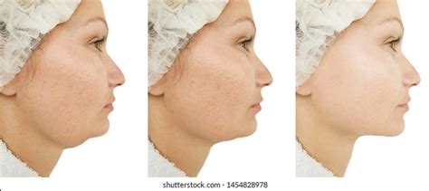 Woman Double Chin Before After Treatment Stock Photo 1454828978 | Shutterstock