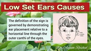 Low Set Ears Causes and Associated Anomalies | Pediatrics | Doovi