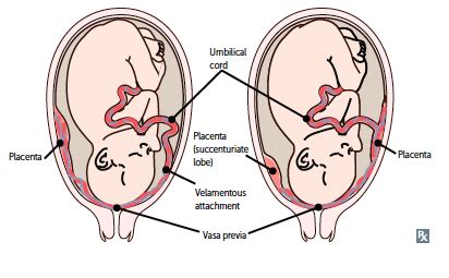 Vasa Previa VS Placenta Previa Symptoms, Management And Treatment