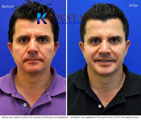 Forehead Botox in San Diego for Men Before & After Gallery 22 | Dr. Kolstad - San Diego Facial ...