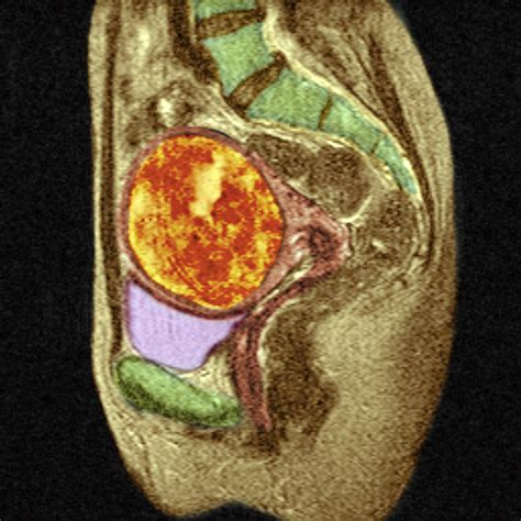 Large Fibroid Uterus Surgery