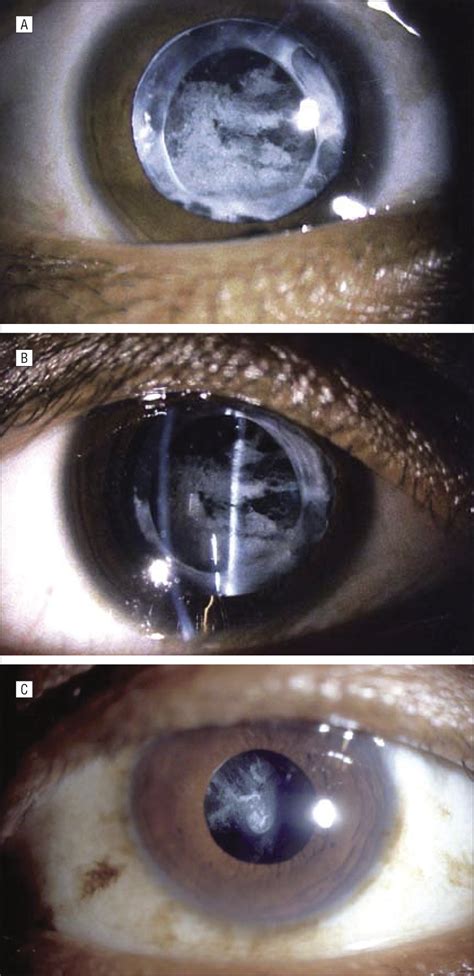 Posterior Capsular Opacification: A Problem Reduced but Not Yet ...