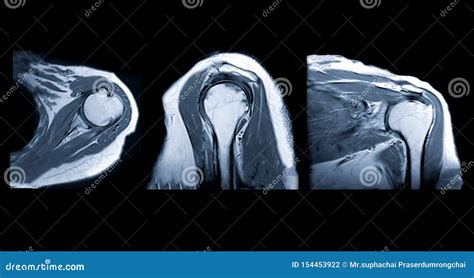 MRI Shoulder Joint Axial, Coronal and Sagittal Plane Stock Photo ...