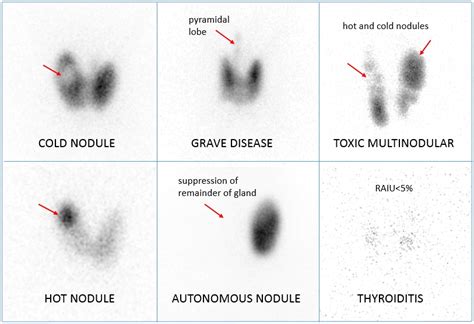 My Notes for USMLE — Thyroid hormone disorders RAIU: RadioActive Iodine...