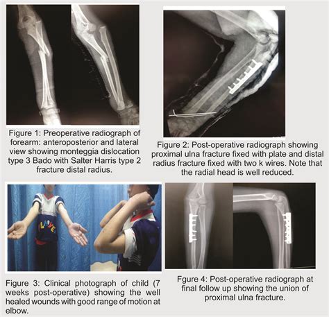 Monteggia Fracture Dislocation with Ipsilateral Distal Radius – Ulna Fracture in a Child ...