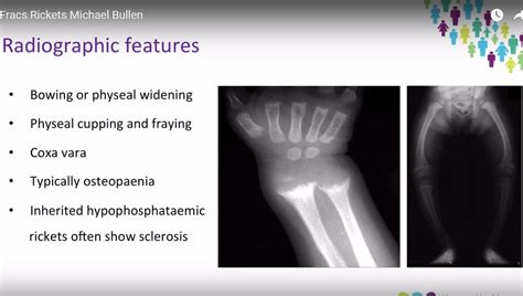 Pathophysiology and Clinical Features of Rickets — OrthopaedicPrinciples.com