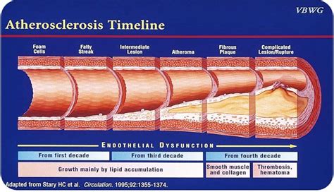 Abdominopelvic Atherosclerosis