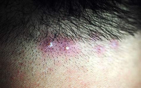 Folliculitis Scalp