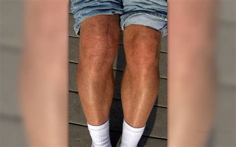 Torn cartilage in knee | General center | SteadyHealth.com