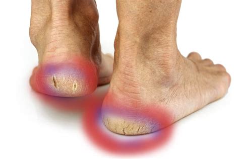 Skin Conditions | Foot Treatment in Launceston, Cornwall | Podiatrist