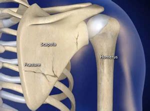 Scapular Fracture - Causes, Symptoms, and Treatment