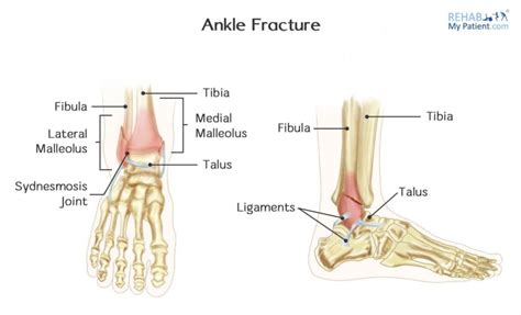 Ankle Sprain vs. Fracture Treatment | Cawley Physical Therapy