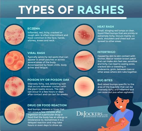 Allergic Rash (... - Dr CAJ Thompson & Dr M De Villiers