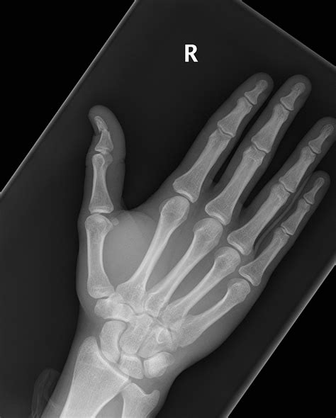 Thumb distal phalanx fracture | Image | Radiopaedia.org