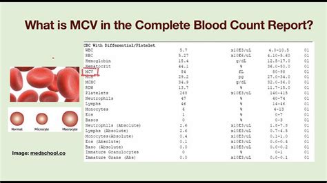 What is MCV? Why my MCV value is abnormal? - YouTube