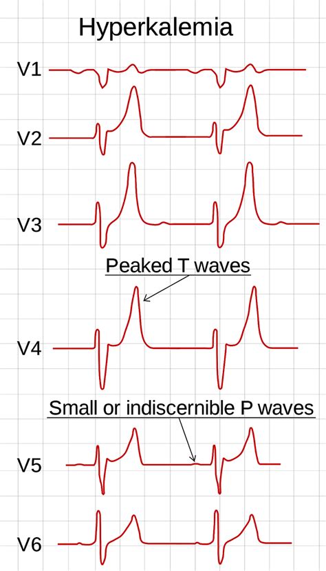 ECG afwijkingen bij Hypo en Hyperkaliemie// - Acute Zorg Blog