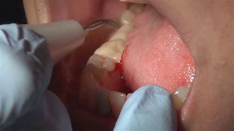 How to do Full Mouth Debridement - YouTube