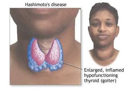 How to Recognize Synthroid Side Effects