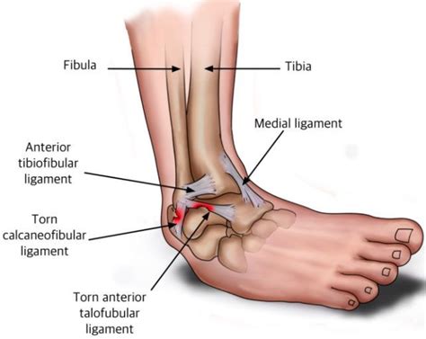 FMPA - How To Rehab An ATFL Ankle Injury In Football With Empowerband