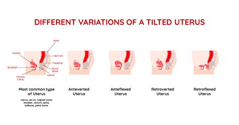 The Best Menstrual Cup for a Tilted Uterus & How to Use It