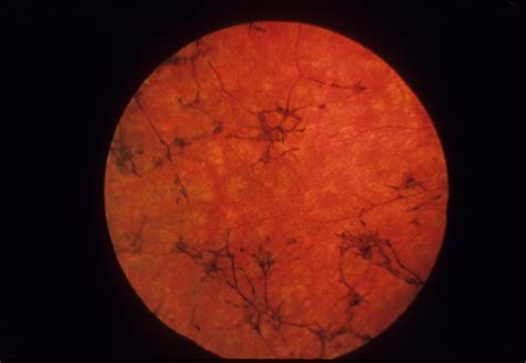 Usher Syndrome Type I | Hereditary Ocular Diseases