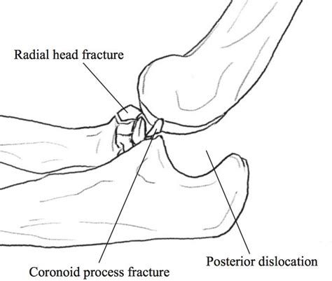 Terrible Triad Injury of Elbow - Trauma - Orthobullets