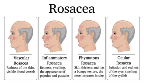 Rosacea Awareness Month — Mountainside Medical Equipment