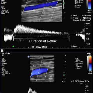 Parents Network Life: Venous Reflux Ultrasound Grading