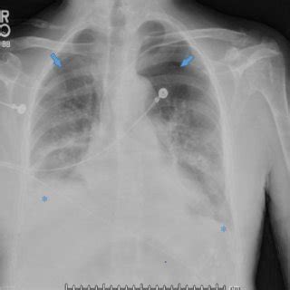 Chest x-ray after feeding tube was removed, revealing bilateral apical ...