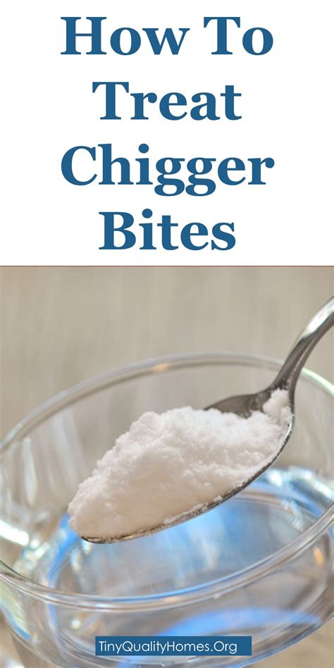 How To Treat Chigger Bites – 26 Home Remedies – Quote Commentary