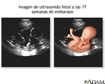 Ultrasonido a las 17 semanas: MedlinePlus enciclopedia médica illustración