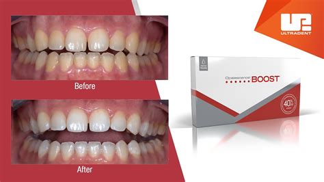 What to Expect with Opalescence Boost Professional Teeth Whitening ...