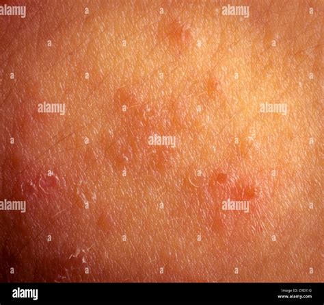 eczema atopic dermatitis symptom skin texture Stock Photo - Alamy