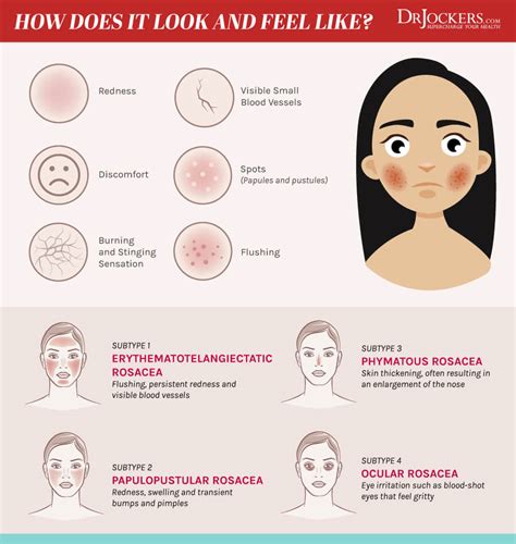 Rosacea: Causes and Natural Support Strategies - DrJockers.com