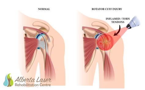 Case Study : Supraspinatus Tendon Tear