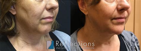 Defyne & Voluma Chin Filler Results for NJ Woman Before & After Photos ...