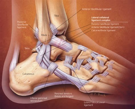 Ankle Sprain | Sprained ankle, Ankle ligaments, Ankle anatomy