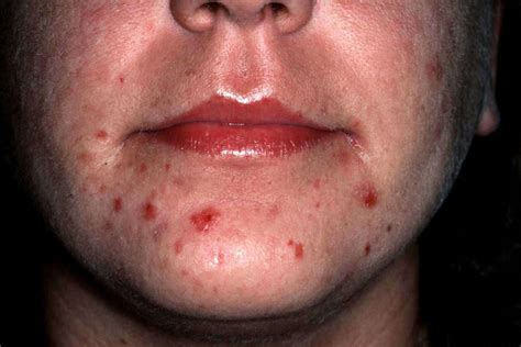 acne excoriee - pictures, photos