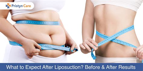 What to Expect After Liposuction Surgery? - Results From Before And After - Pristyn Care